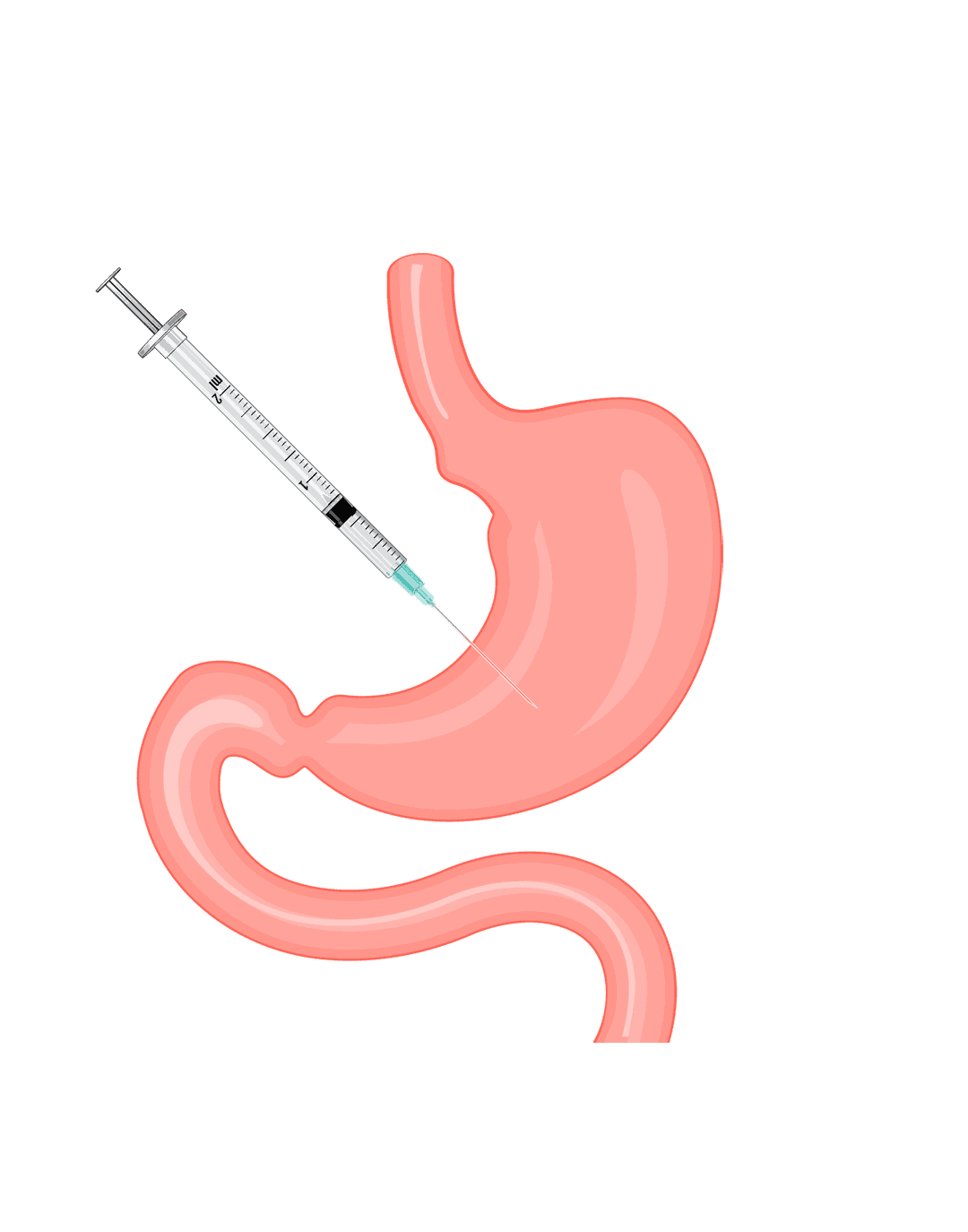 BARIATRIC SURGERY - Marietta